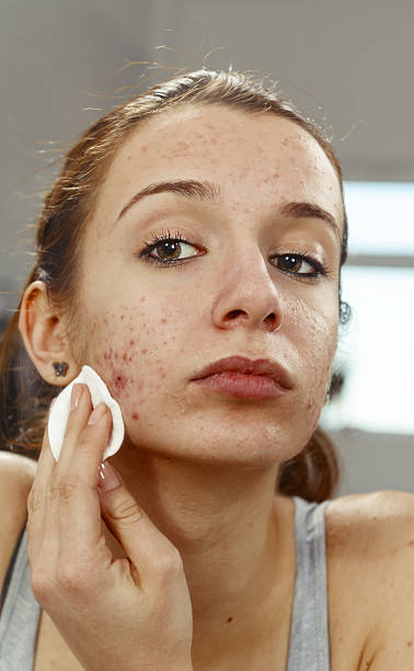 Best Natural Skin Products for Acne