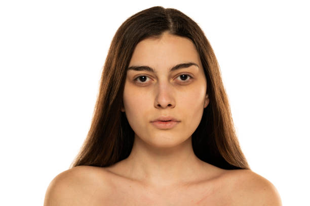How to Get Rid of Dark Circles Under Your Eyes