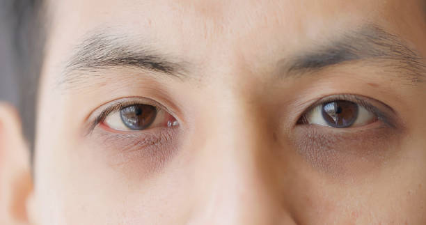 How to Get Rid of Dark Circles Under Your Eyes